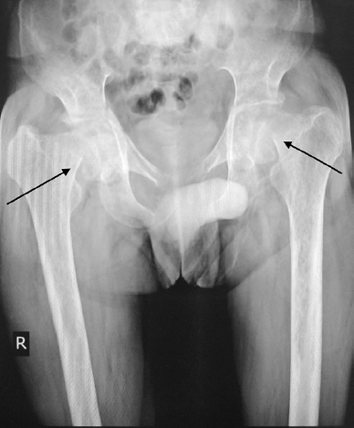 Bilateral malunited subcapital neck femur fractures (arrows) and coxa vara deformity.